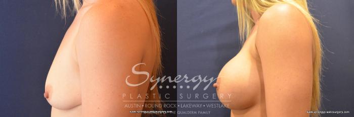 Before & After Breast Augmentation Case 725 View #2 View in Austin, TX