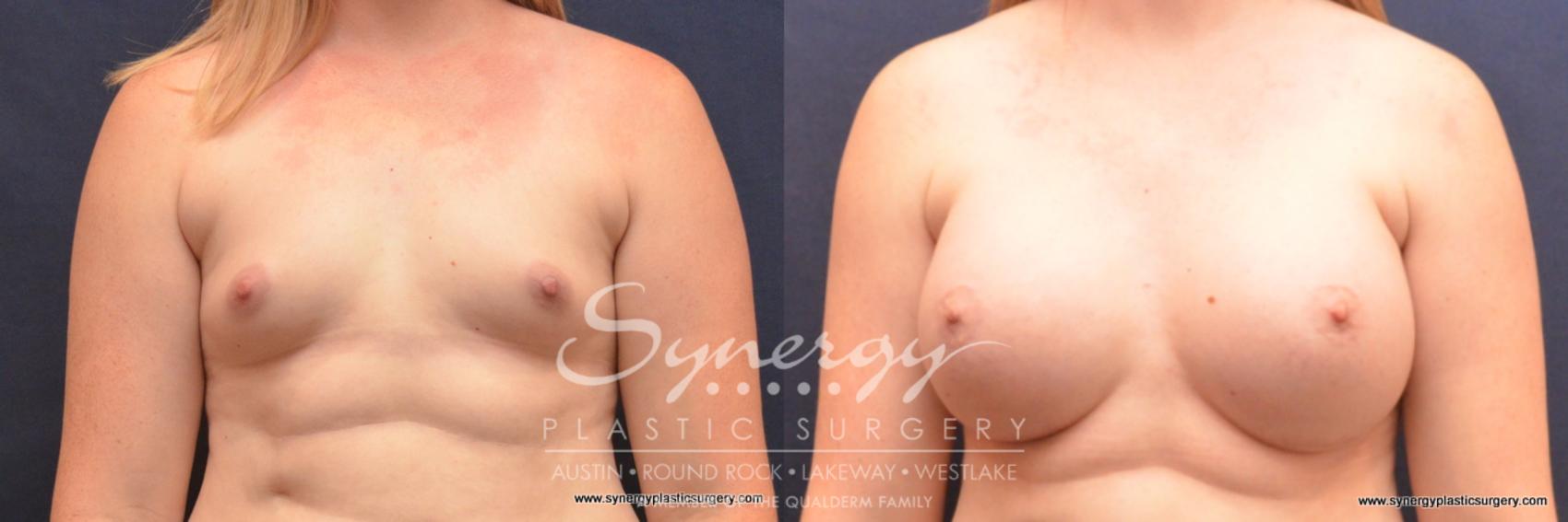 Before & After Breast Augmentation Case 727 View #1 View in Austin, TX