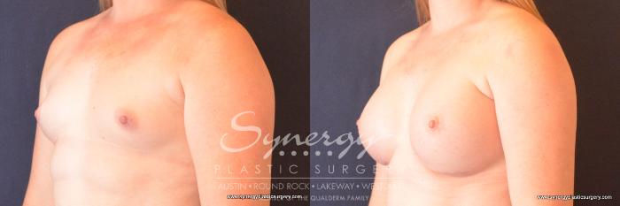 Before & After Breast Augmentation Case 727 View #2 View in Austin, TX