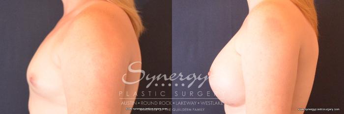 Before & After Breast Augmentation Case 727 View #3 View in Austin, TX