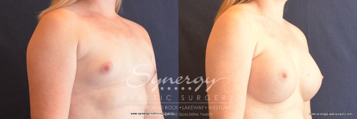 Before & After Breast Augmentation Case 727 View #4 View in Austin, TX