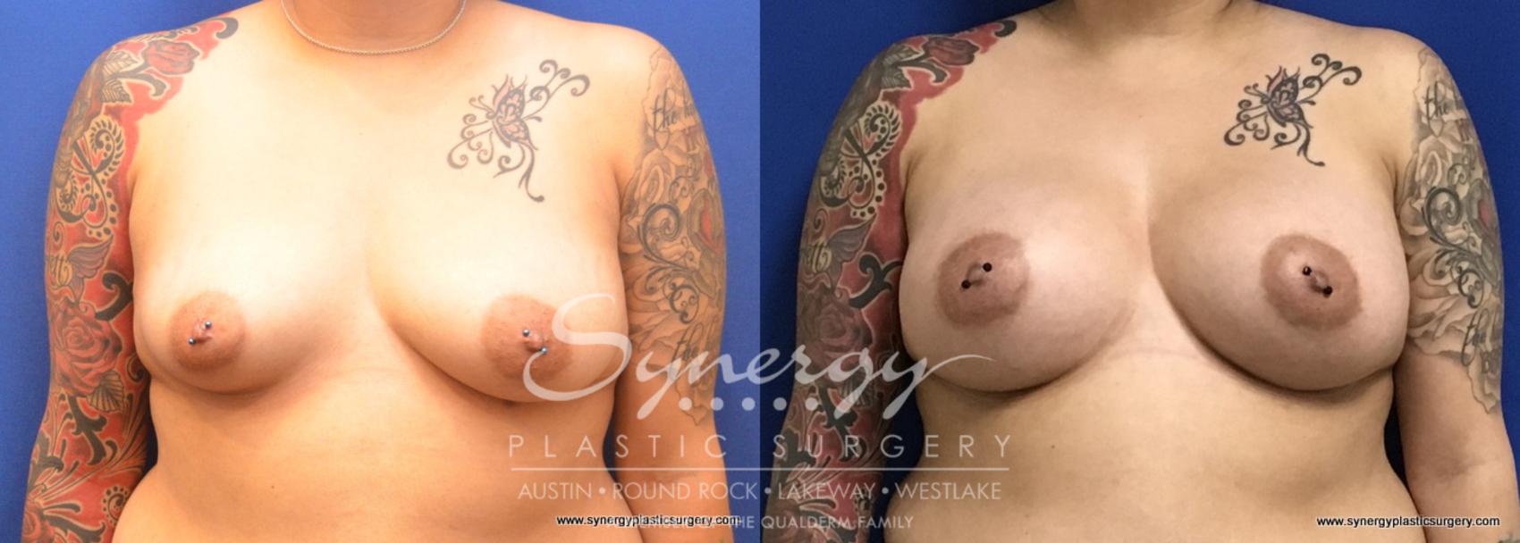 Before & After Breast Augmentation Case 728 View #1 View in Austin, TX