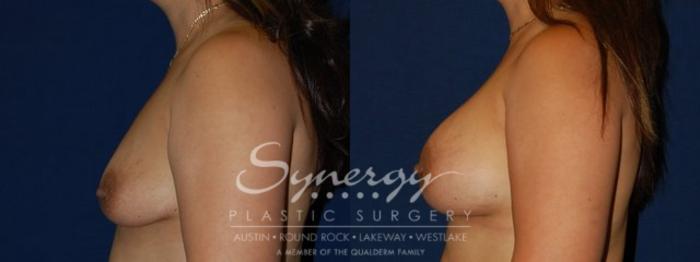 Before & After Breast Augmentation Case 73 View #3 View in Austin, TX