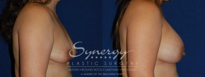 Before & After Breast Augmentation Case 73 View #4 View in Austin, TX