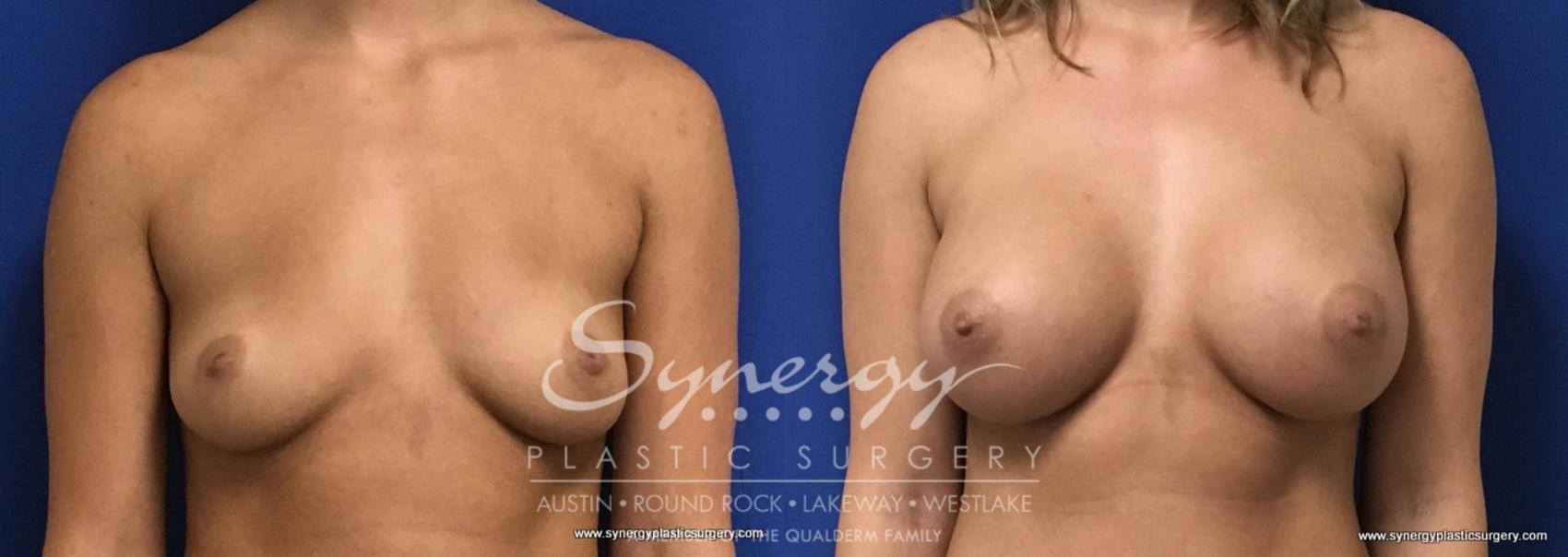 Before & After Breast Augmentation Case 730 View #1 View in Austin, TX