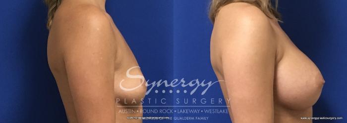 Before & After Breast Augmentation Case 730 View #2 View in Austin, TX