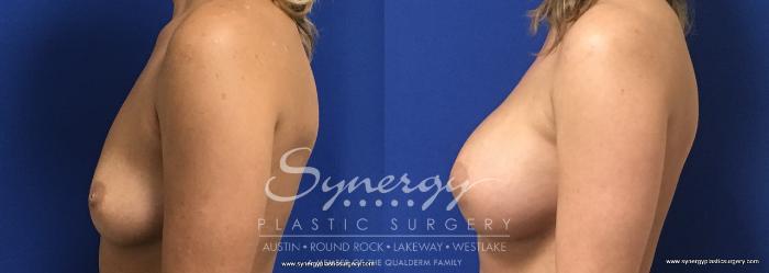 Before & After Breast Augmentation Case 730 View #4 View in Austin, TX
