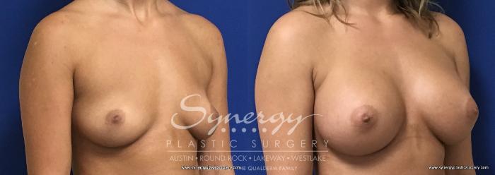 Before & After Breast Augmentation Case 730 View #5 View in Austin, TX