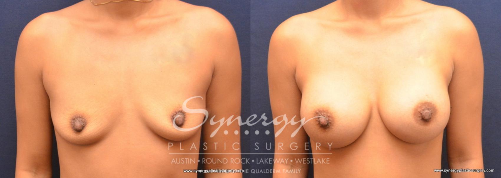 Before & After Breast Augmentation Case 731 View #1 View in Austin, TX