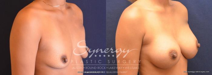 Before & After Breast Augmentation Case 731 View #2 View in Austin, TX