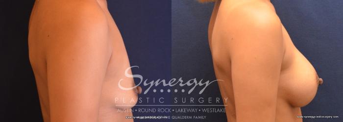 Before & After Breast Augmentation Case 731 View #3 View in Austin, TX