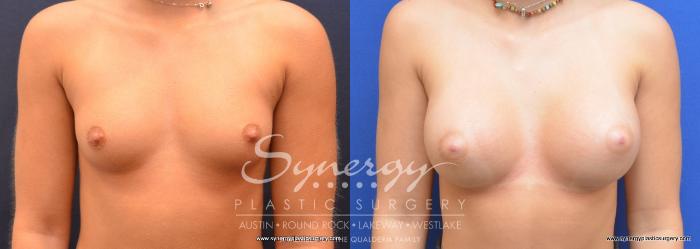 Before & After Ballerina/Yoga Breast Augmentation Case 733 View #1 View in Austin, TX
