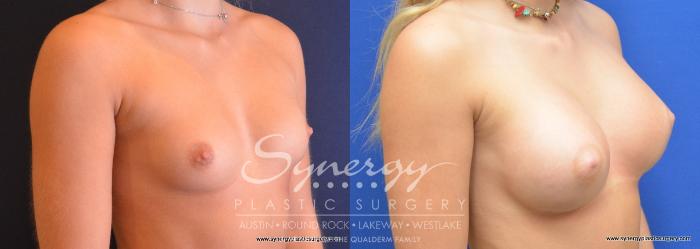 Before & After  Case 733 View #2 View in Austin, TX