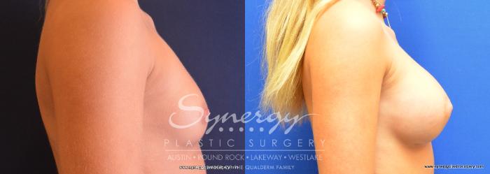 Before & After  Case 733 View #3 View in Austin, TX