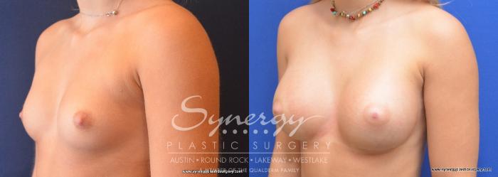 Before & After  Case 733 View #4 View in Austin, TX