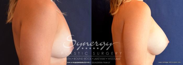 Before & After Breast Augmentation Case 734 View #2 View in Austin, TX