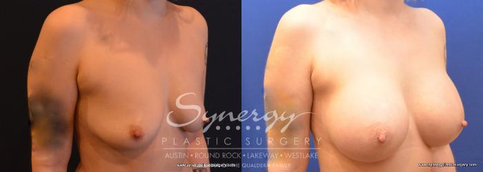 Before & After Breast Augmentation Case 741 View #2 View in Austin, TX