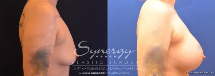 Before & After Breast Augmentation Case 741 View #3 View in Austin, TX