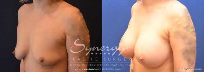 Before & After Breast Augmentation Case 741 View #4 View in Austin, TX