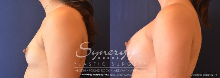 Before & After Breast Augmentation Case 744 View #3 View in Austin, TX