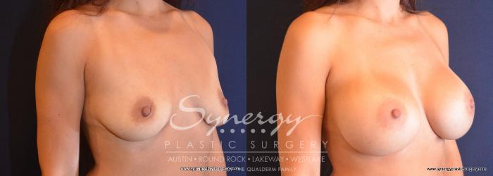 Before & After Breast Augmentation Case 745 View #4 View in Austin, TX
