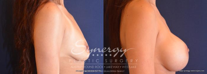 Before & After Breast Augmentation Case 745 View #5 View in Austin, TX