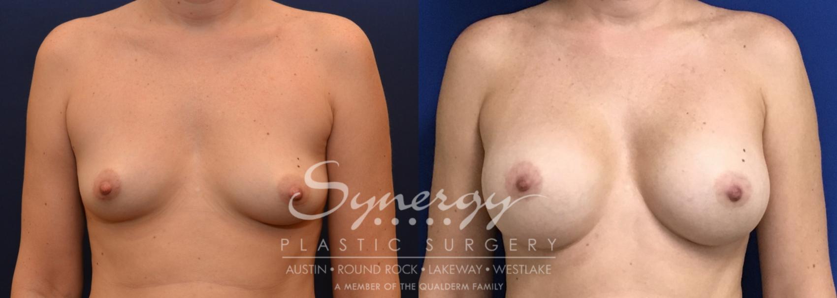 Before & After Breast Augmentation Case 747 View #1 View in Austin, TX
