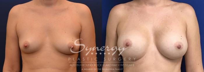 Before & After Breast Augmentation Case 747 View #1 View in Austin, TX