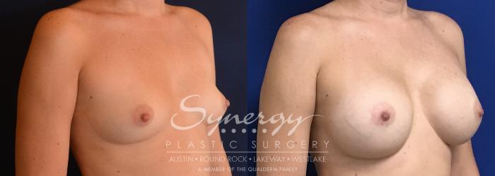Before & After Breast Augmentation Case 747 View #2 View in Austin, TX