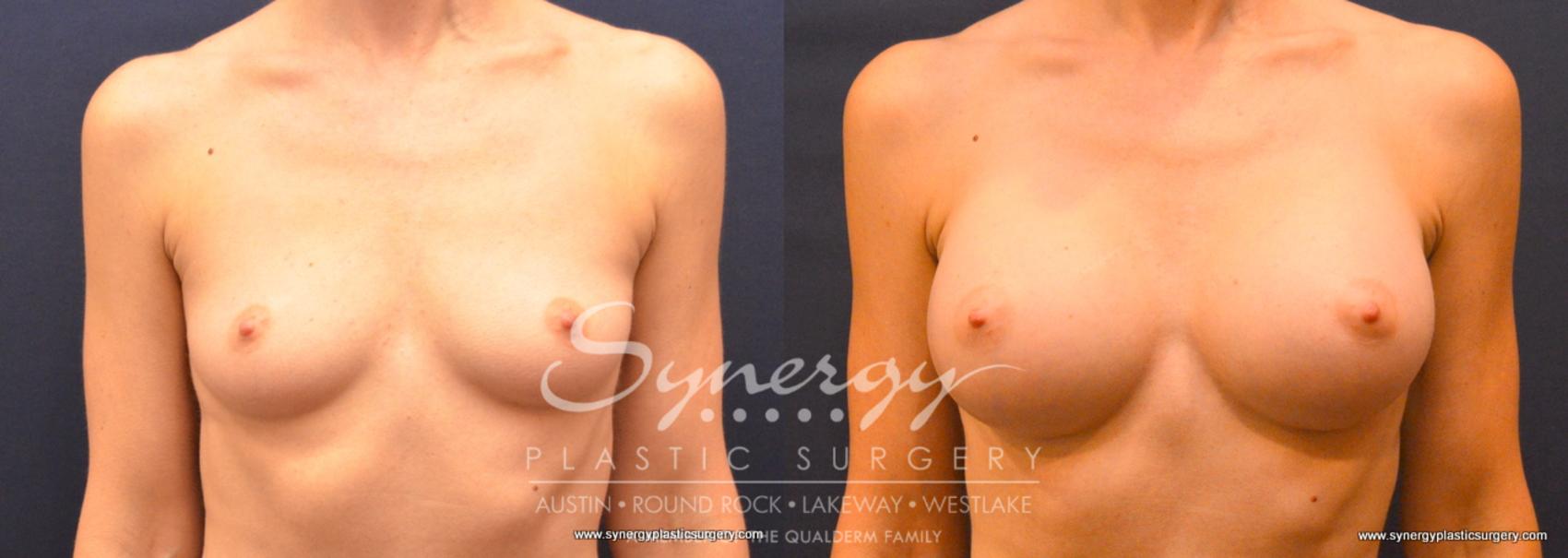 Before & After Breast Augmentation Case 749 View #1 View in Austin, TX