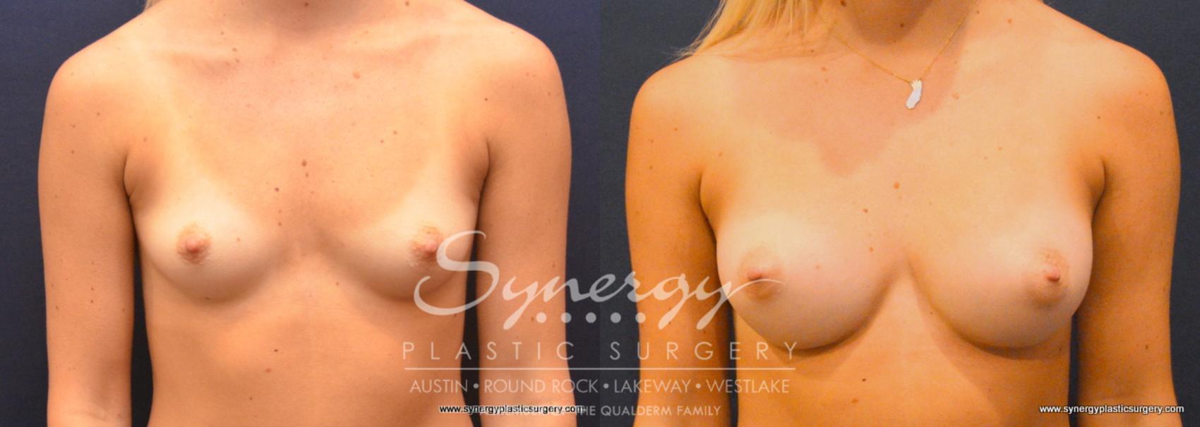 Before & After Breast Augmentation Case 754 View #1 View in Austin, TX