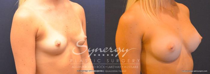 Before & After Breast Augmentation Case 754 View #2 View in Austin, TX
