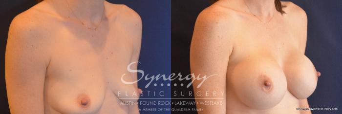 Before & After Breast Augmentation Case 755 View #4 View in Austin, TX