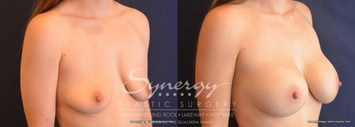 Before & After Breast Augmentation Case 757 View #4 View in Austin, TX