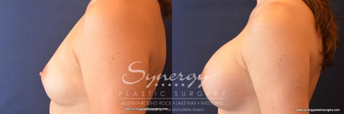 Before & After Breast Augmentation Case 786 View #3 View in Austin, TX
