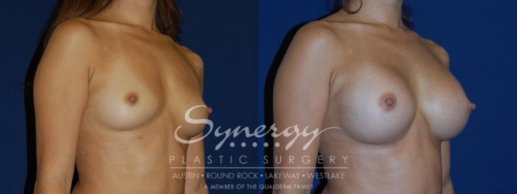 Before & After Breast Augmentation Case 80 View #1 View in Austin, TX