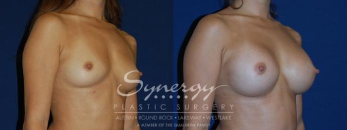 Before & After Breast Augmentation Case 80 View #1 View in Austin, TX