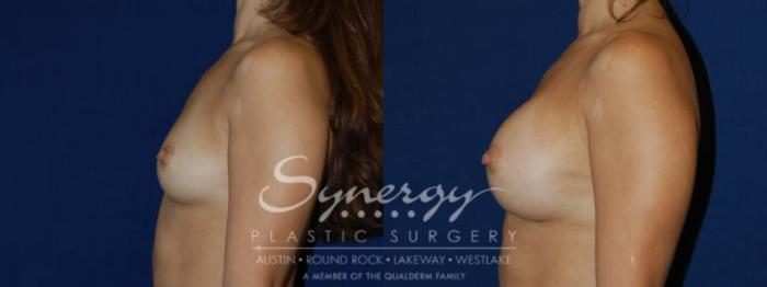 Before & After Breast Augmentation Case 80 View #4 View in Austin, TX