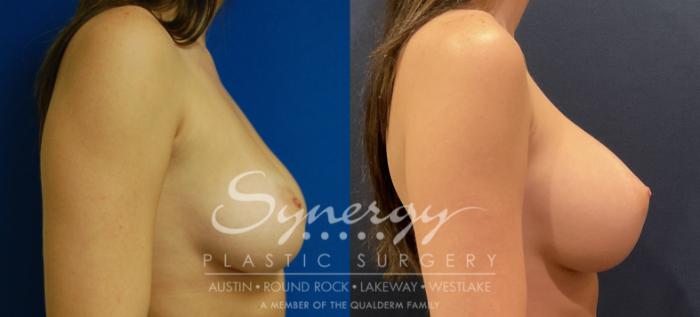 Before & After Breast Augmentation Case 801 Right Side View in Austin, TX
