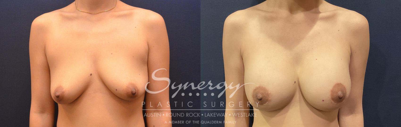 Breast Augmentation, Synergy Plastic Surgery, Silicone 