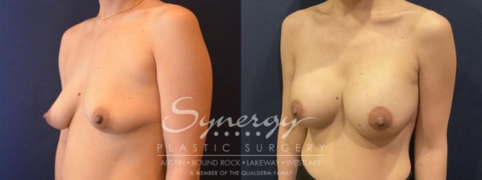 Breast Augmentation, Synergy Plastic Surgery, Silicone 