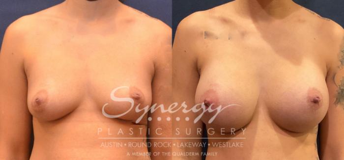 Breast Augmentation, Synergy Plastic Surgery, Silicone 