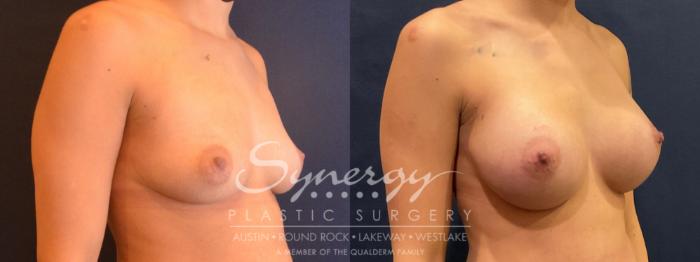 Breast Augmentation, Synergy Plastic Surgery, Silicone 