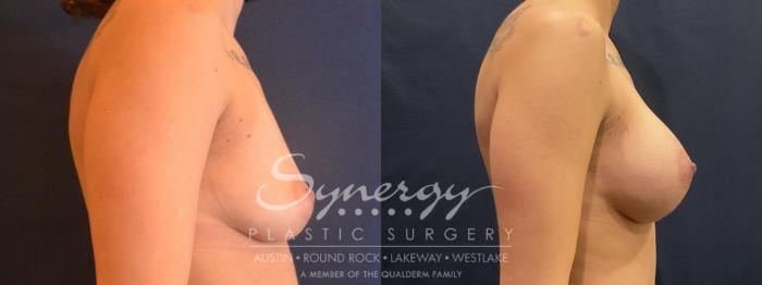 Breast Augmentation, Synergy Plastic Surgery, Silicone 
