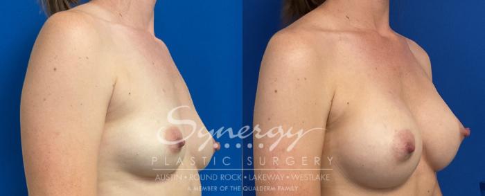 Breast Augmentation, Synergy Plastic Surgery