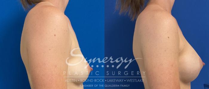 Breast Augmentation, Synergy Plastic Surgery