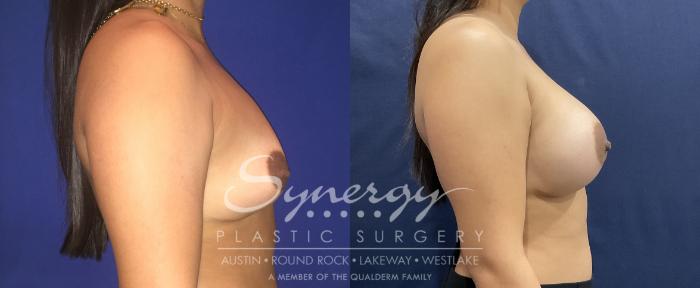Before & After Breast Augmentation Case 808 Left Side View in Austin, TX