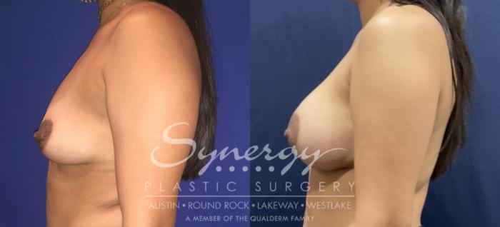 Before & After Breast Augmentation Case 808 Right Side View in Austin, TX