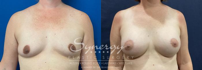Before & After Breast Augmentation Case 810 Front View in Austin, TX