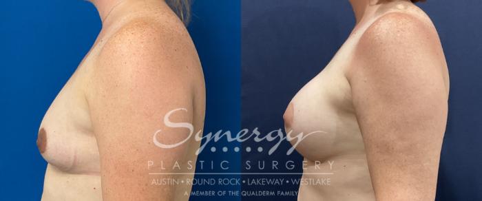 Before & After Breast Augmentation Case 810 Right Side View in Austin, TX